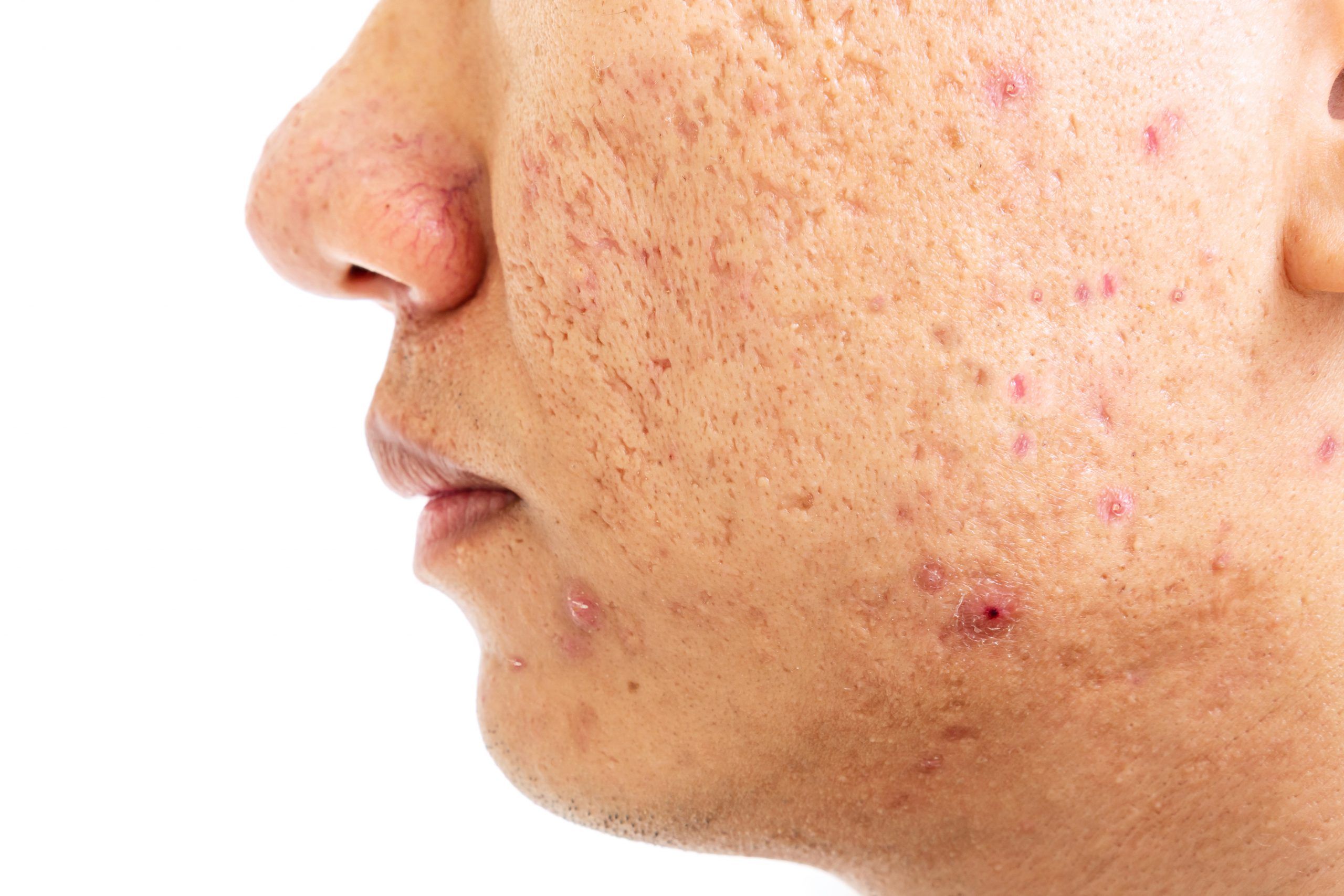 Close up of problematic skin with deep acne scars on cheek men p