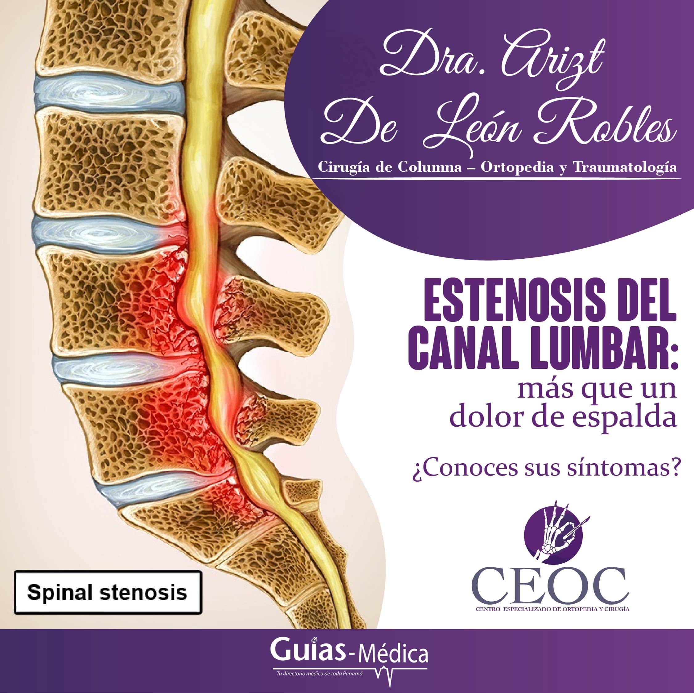 Estenosis Del Canal Lumbar Más Que Un Dolor De Espalda Guía Médica 7464